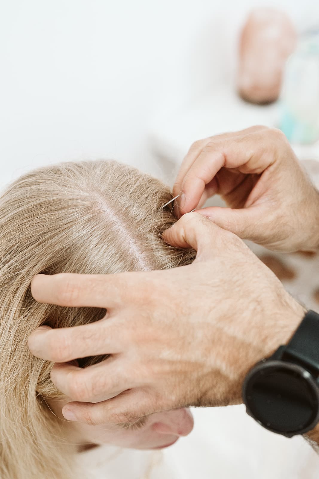 תמונה המציגה YNSA דיקור ראש